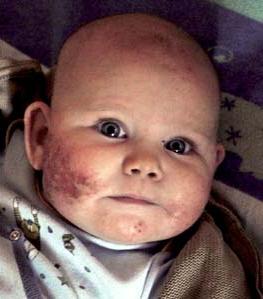 乳児のアトピー性皮膚炎